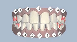 เคส 5 เคสฟันยื่น ฟันหน้าบนยื่น และยาวไม่เท่ากัน (1 )