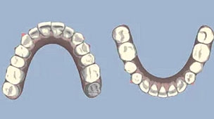 เคส 7 เคสฟันยื่นมาก ทั้งฟันบนและฟันล่าง รักษาโดยการจัดฟันแบบ Invisalign