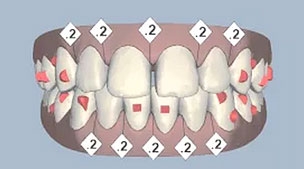 เคส 8 เคสฟันห่าง รักษาโดยการจัดฟันแบบ Invisalign Lite