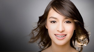 จัดฟันแบบลวด