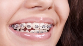 การทำความสะอาดฟันและเหงือกสำหรับผู้จัดฟัน