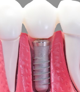 รากเทียม