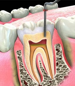 การรักษาคลองรากฟัน