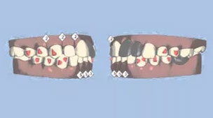 เคส 3 เคสหน้าเบี้ยว ฟันเก ฟันล่างคร่อมฟันบนบางตำแหน่ง (2)