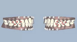 เคส 5 เคสฟันยื่น ฟันหน้าบนยื่น และยาวไม่เท่ากัน ( 2)