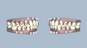 เคส 6 เคสฟันยื่น รักษาโดยการจัดฟันแบบ Invisalign ใช้ระยะเวลาในการจัดเพียง 10 เดือนเท่านั้น