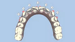 เคส 10 เคสฟันเกทั้งฟันบนและฟันล่าง รักษาโดยการจัดฟันแบบ Invisalign (1)