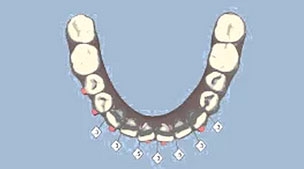 เคส 10 เคสฟันเกทั้งฟันบนและฟันล่าง รักษาโดยการจัดฟันแบบ Invisalign (2)