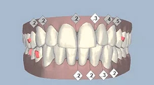 เคส 11 เคสจัดฟันแบบใสไร้ลวด (Invisalign) (1)