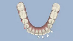 เคส 11 เคสจัดฟันแบบใสไร้ลวด (Invisalign) (2)